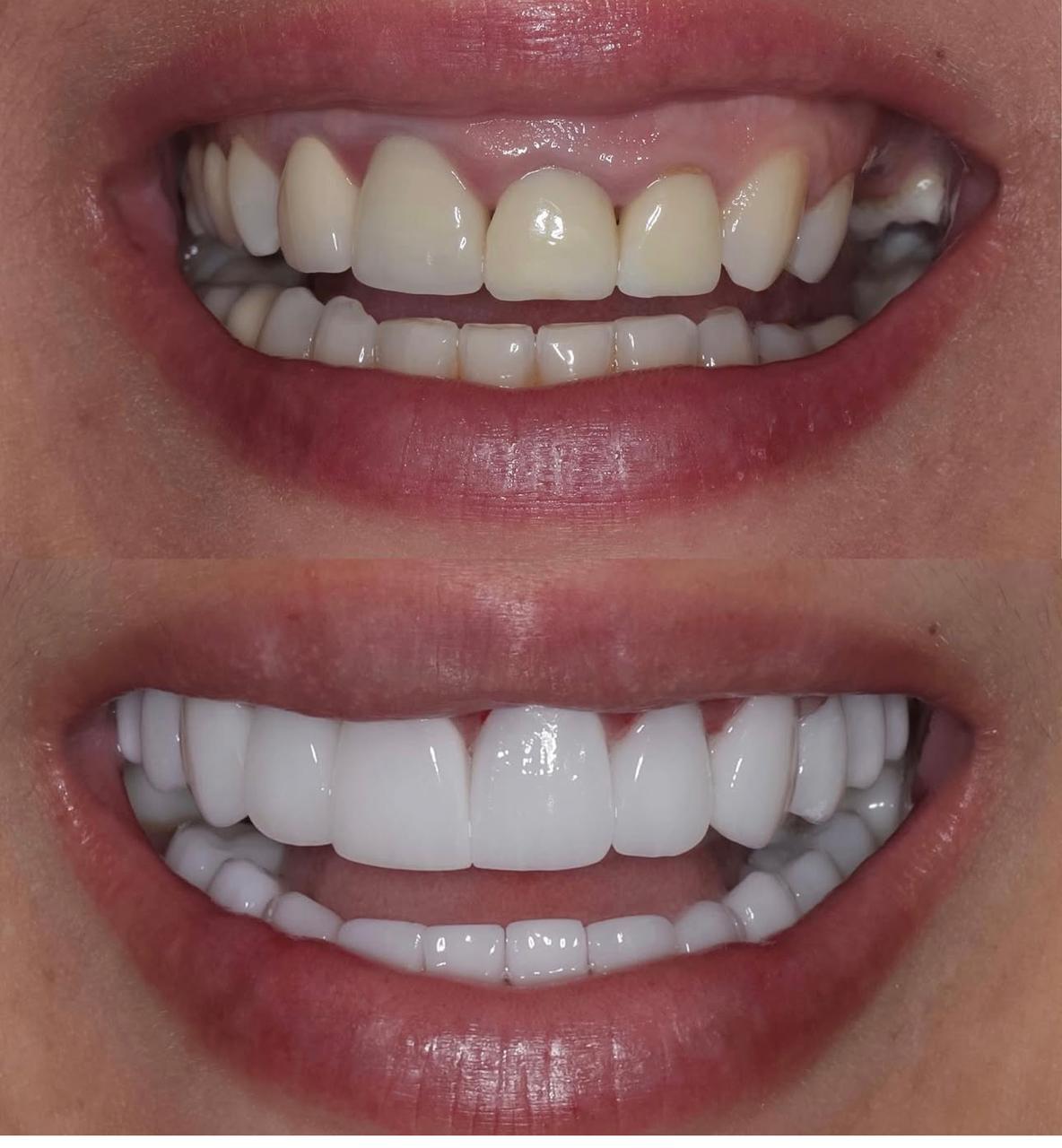 Antes e depois de sorriso 2